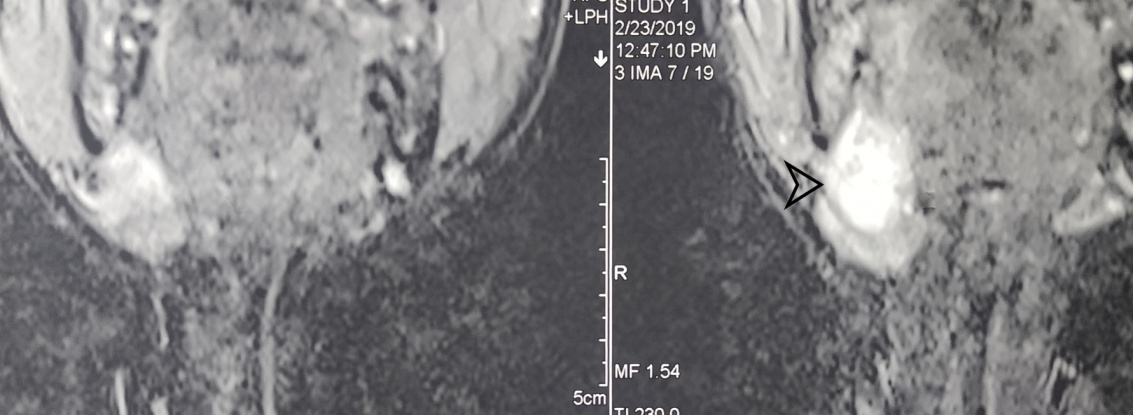 Contrast MRI