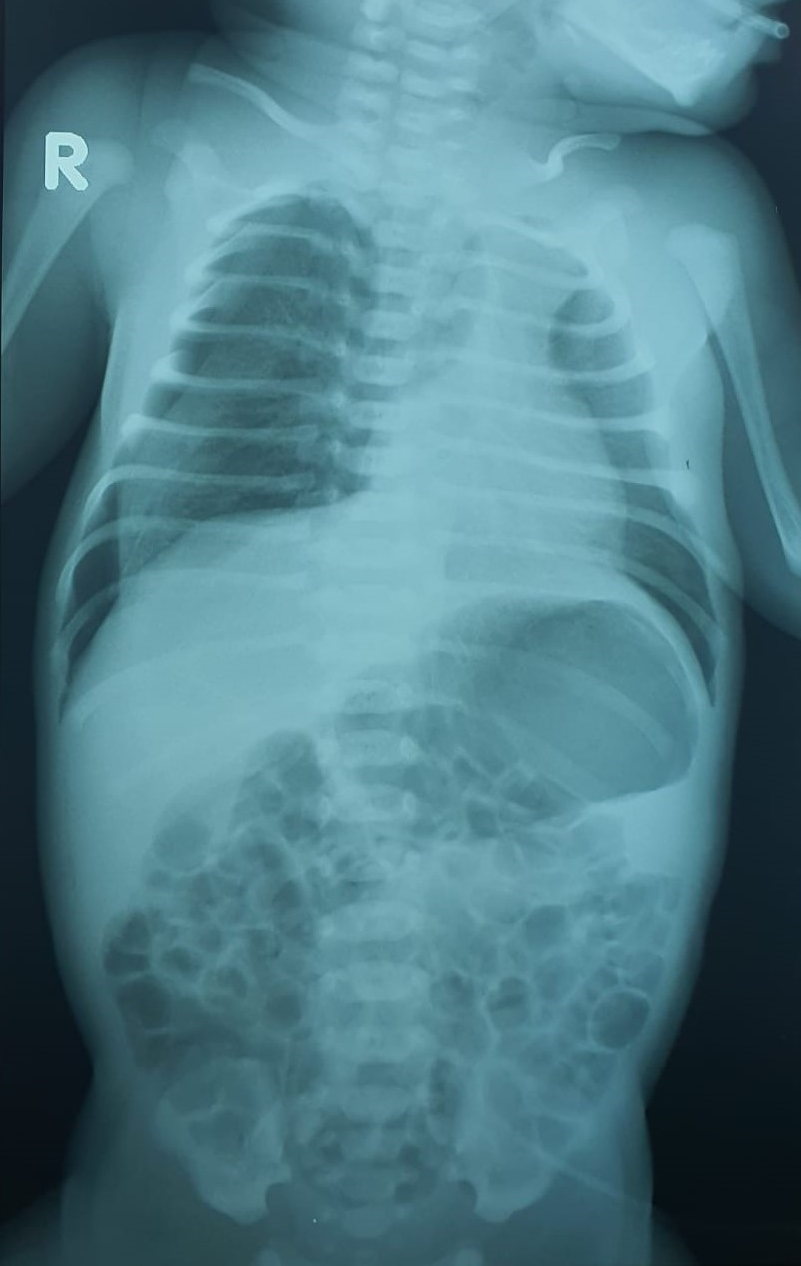 Chest x-ray showing right side pneumothorax