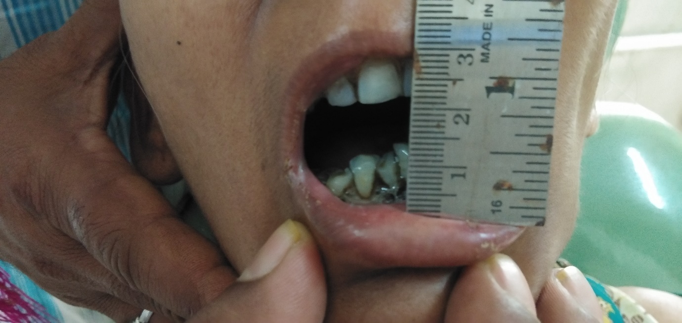 TMJ open and close view