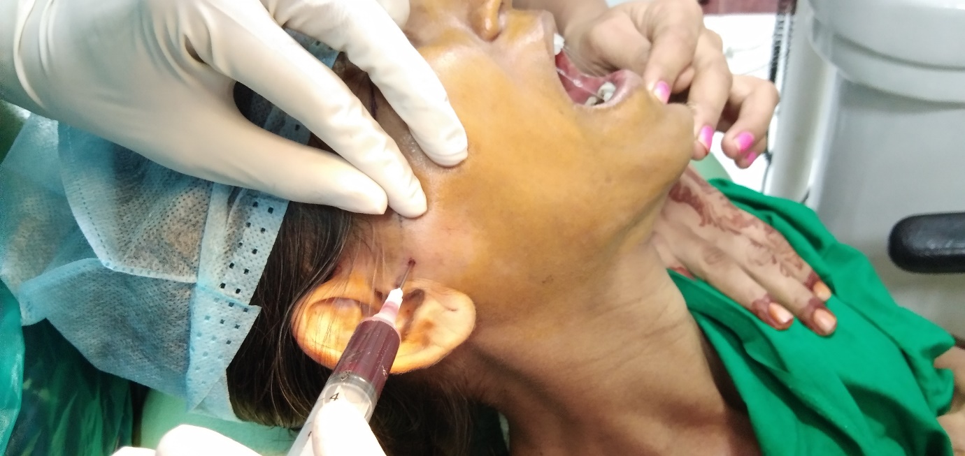Autologous blood injected in TMJ  