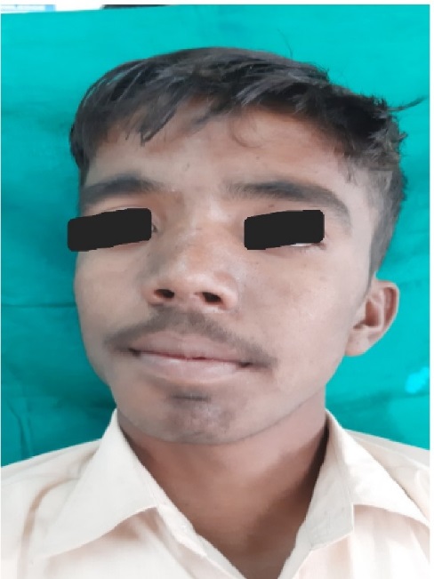 Presence of frontal bossing, broad nasal bridge and hypertelorism