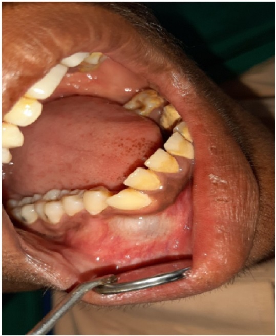 Shows intra oral swelling in buccal vestibule in canine region