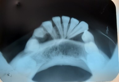 Occlusal radiograph showing well defined radiolucency and pathological migration of teeth.