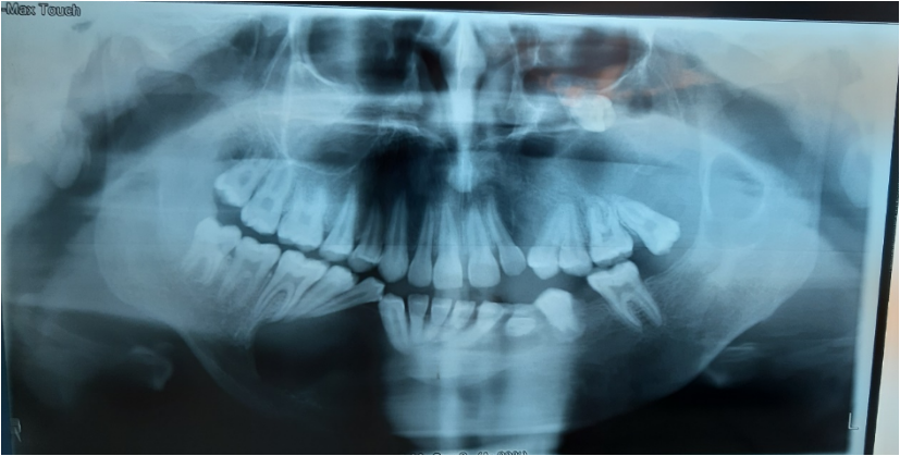 Panoramic radiograph shows multiple well-deﬁned multilocular radiolucencies with presence of sclerotic border into the maxilla and mandible.