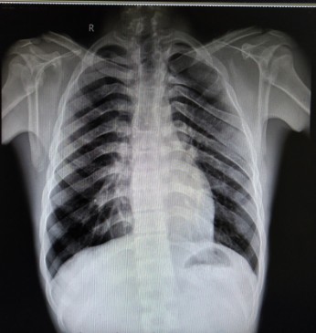 Chest radiograph showing a biﬁd right fourth rib.
