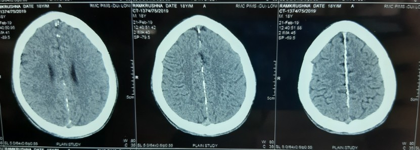 Calcification of falx cerebri in computed tomography sca