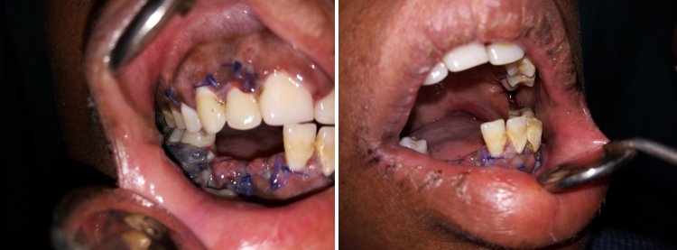 The incisional biopsy was advised from the lesion. Presence of abundant keratin 