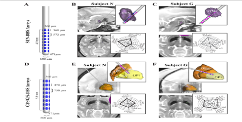 Stimulations of s-nuclei and pallidal neurons with deep brain stimulator and their course-directions in Parkinsonians. Figures A and D. Stimulus-arrayscomprised of rows-and-4columnsof electrode-places amid slighter-electrode sizes and inter-electrode spacing’s of s-nuclei-dbs-arraysB and C-than pallidal-neuronal-arrays E and F. Polar plots indicate either stimulus amplitude thresholds to evoke muscle twitches E,F or stimulus-induced electromyography-voltages-peakC-while inducing through electrodes along a single-column. 