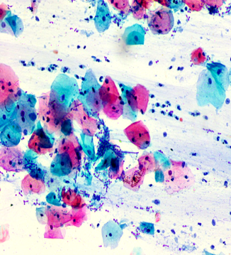 Candidial hyphae and spores