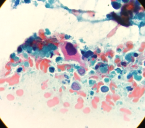 Squamous cell carcinoma CERVIX