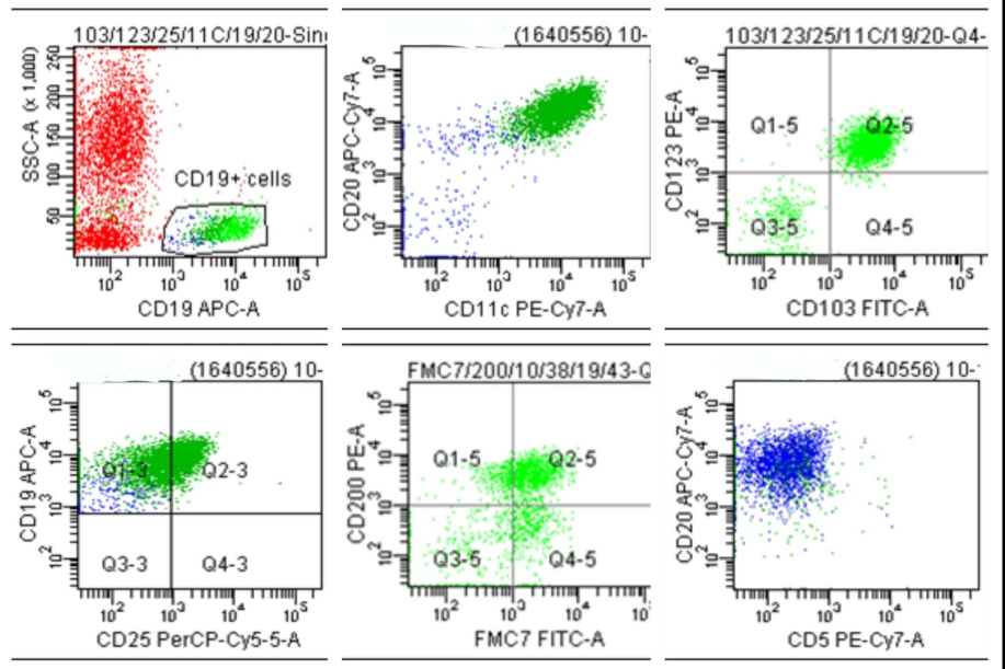 Flow cytometric analysis of CD19 positive singlet cells revealed the expression of bright CD20, with co-expression of CD11c/ CD123/ CD103/ CD25/ FMC7 and negative for CD5.