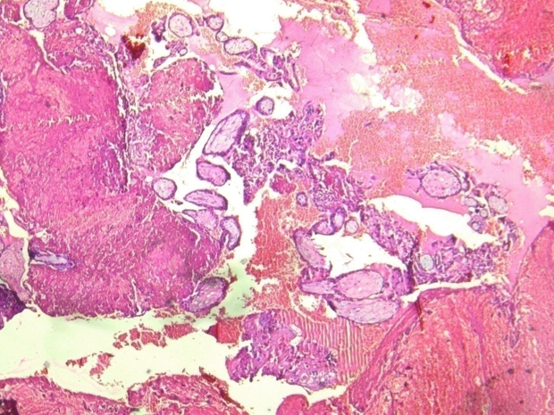 Blood clot with chorionic villi