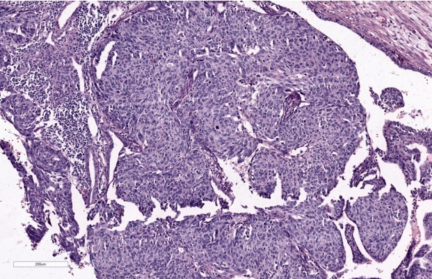 Intraluminal atypical proliferation of mucosal epithelium H&E (10X)