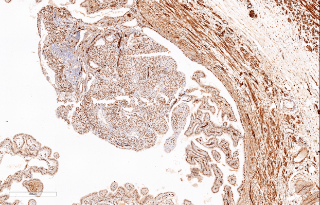 Diffuse and strong positivity of WT-1