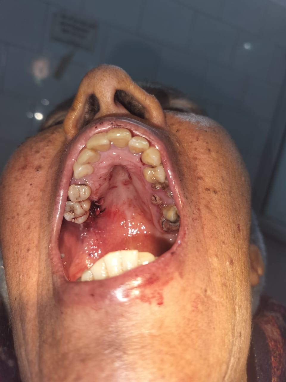 Post excision of the lesion