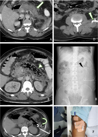 A: Axial contrast-enhanced CT image shows heterogenously enhancing bulky pancreas with extensive adjacent fat stranding and peripancreatic fluid collection.; B: Axial contrast-enhanced CT done after 3 weeks shows active necrotizing pancreatitis with pancreatic parenchymal, peripancreatic necrosis with a large necrotic collection with superimposed air foci-suggestive of super added infection.; C: Axial Check CT image after first pig tail insertion showing well positioned pig tail tip in the pancreatic tail.; D: Axial Check CT after second pig tail insertion showing well positioned pig tail tip in the left parapsoas collection.; E: Scout image showing two well positioned pig tail.; F: Post Pigtail insertion in patient.
