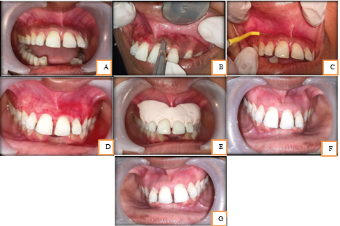 (a): Pre-operative (b): With scalpel (c): Electrode (d): Intra-operative (e): Periodontal dressing (f): Post-operative After 3 months (g): Post-operative after 6 months