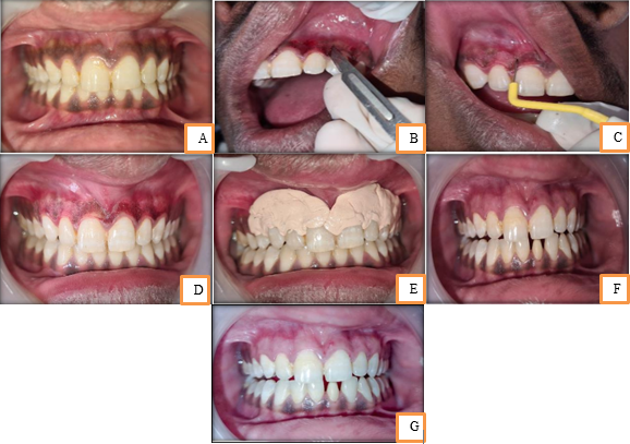 (a): Pre-Operative (b): With Scalpel (c): Intra-Operative (d): Periodontal dressing (e): Post-operative after 3 months (f): Post-Operative After 6 month