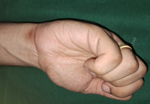 Presence of gamer’s mark on the wrist of a participant