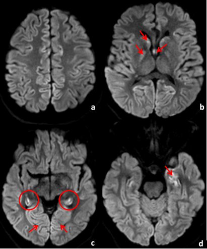 MR DWI showing restriction diffusion in; a): Cortical regions; b): The caudate nuclei, lentiform nucleus and the forniceal columns; c): Hyperintensity in bilateral hippocampi and medial occipital lobes; and d): Left amygdala.