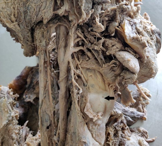 High origin of ICA (black arrow-upper border of thyroid cartilage)