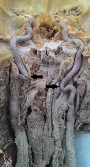 Bilateral kinking of the cervical part of the ICA