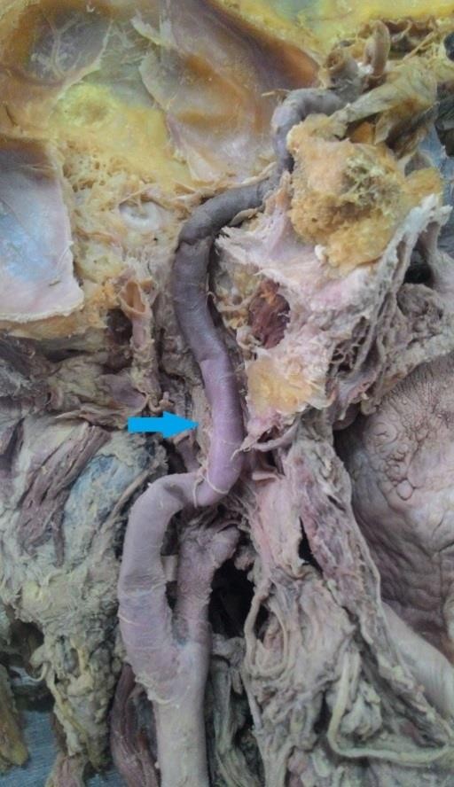 Curving of the cervical part (blue arrow)