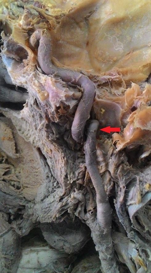 Coiling of the cervical part (red arrow)