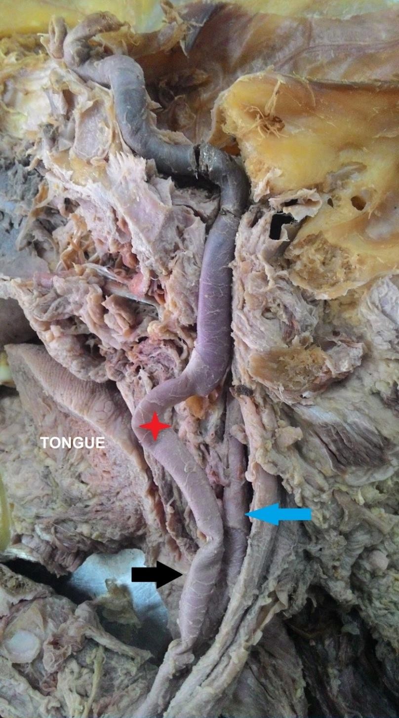 Medialization of the ICA with curve (red star), black arrow-aberrant course, blue arrow - ECA