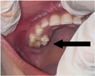 Intraoral view (palatally placed 15, with missing 17 and 18)