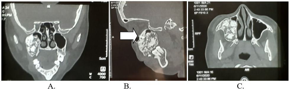 CT scan A: Coronal; B: Sagittal; C: Axial slices showing the tumour