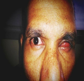 Conjunctivalisation of dermis