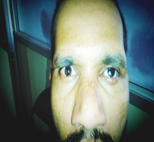 Good cosmesis with Prosthetic eye