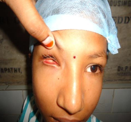 Right pthisical eye