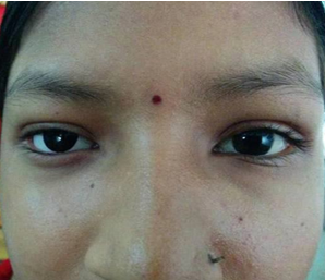 Fair Cosmesis with prosthetic eye