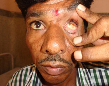 Left Pthisical eye