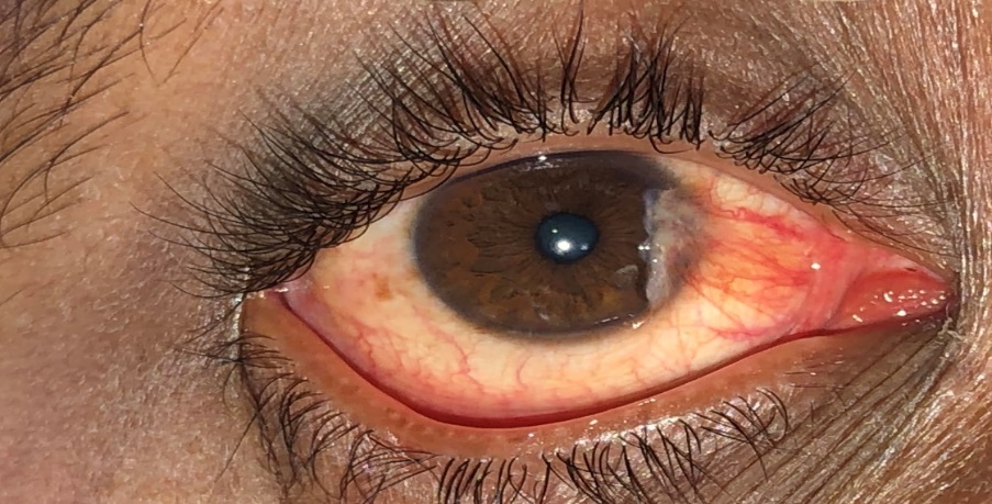 Right eye nasal pterygium.