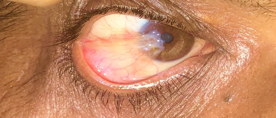 Right eye temporal pterygium.