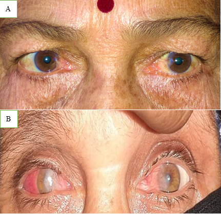 (A,B): Bilateral nasal pterygium.
