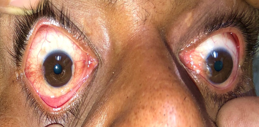 Right eye primary double pterygium (both nasal and temporal) with left eye only nasal pterygium.