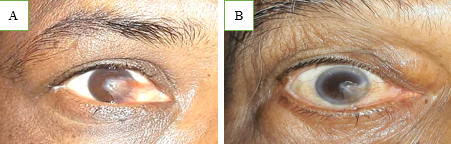 (A, B): Nasal pterygium involving visual axis.