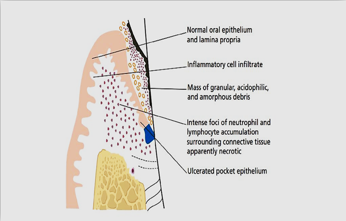 Diagram showing histopathology of periodontal abscess