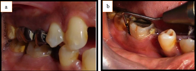 a: Pretreatment intraoral; b: Pretreatment intraoral 11 mm pocket depth is seen on probing
