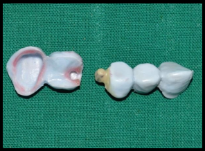 Wax pattern showing anterior female portion and posterior male portion of Pier abutment