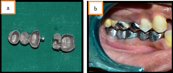 a: Metal framework of pier abutment; b: Metal coping trial