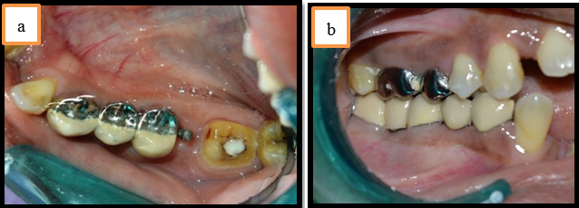 a: Final cementation of anterior segment of pier abutment was done; b: Final cementation of posterior segment of pier abutment was done