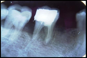 Radiographic evaluation after endodontic treatment done with mesial part of 46