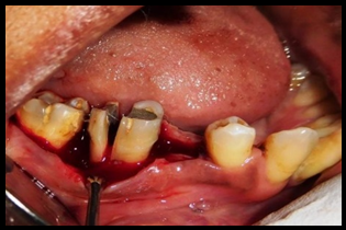 Tooth Sectioning done with 46