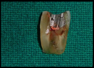 Removed distal root of 46