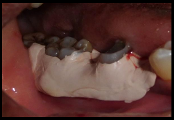 Periodontal dressing given at the surgical site